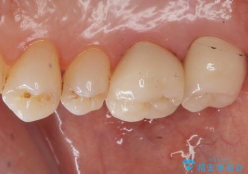 銀歯を白くしたい セラミッククラウンでの治療の治療後