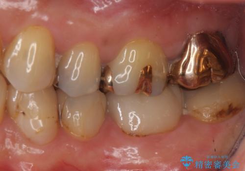 昔いれたクラウンが割れたので金属の被せ物を入れたいの治療前
