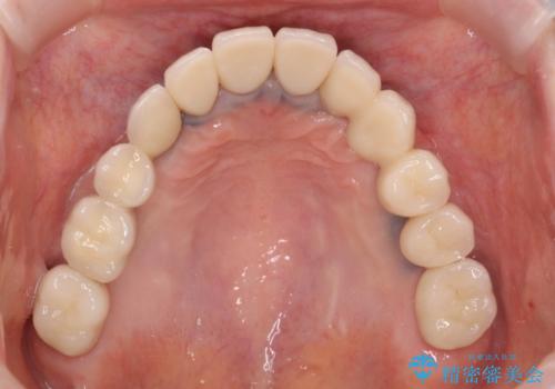 全顎的 虫歯治療 インプラント補綴の治療後