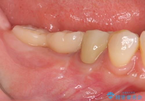 くいしばりで割れたブリッジの支台歯　インプラント再補綴の症例 治療後