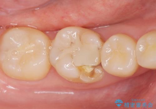 食べ物食べたら歯が欠けた。