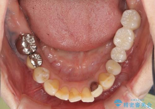 全顎的 虫歯治療 インプラント補綴の治療中