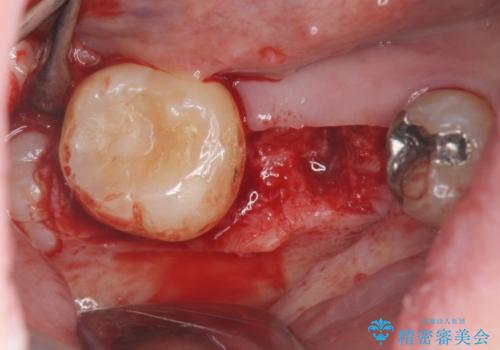 保存不可能な虫歯、インプラントによる機能回復の治療中