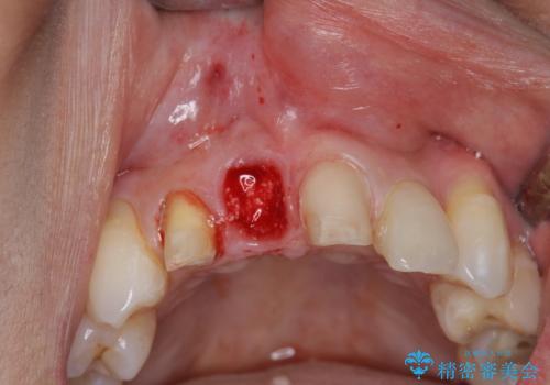 吸収し喪失した前歯、ブリッジによる審美性の回復の治療前