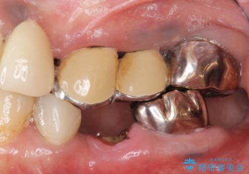 全顎的 虫歯治療 インプラント補綴の治療前
