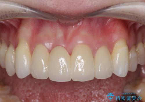 吸収し喪失した前歯、ブリッジによる審美性の回復の治療後