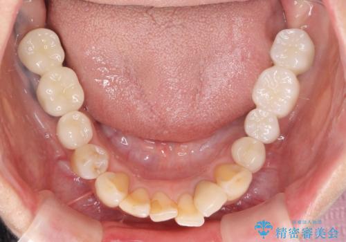 全顎的 虫歯治療 インプラント補綴の治療後