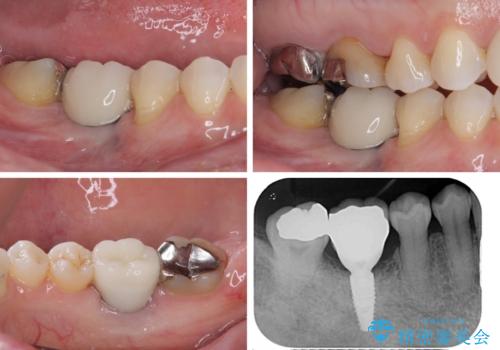 歯が全く咬みあわない 矯正と補綴の全顎治療の治療後