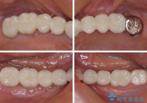 以前治療した歯がボロボロに 全顎補綴治療の治療後
