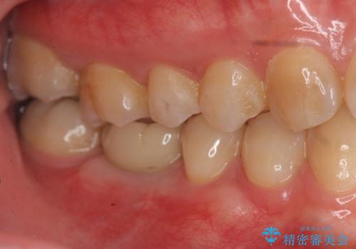 保存不可能な虫歯、インプラントによる機能回復の治療後