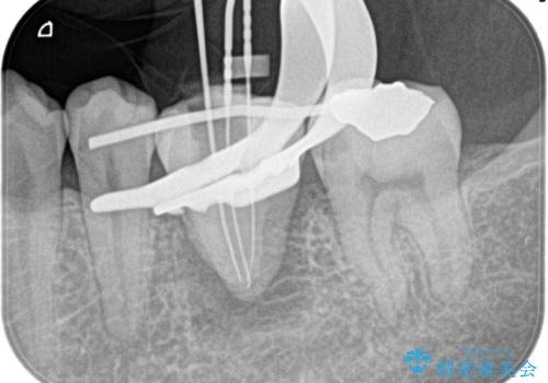 【歯牙移植】親知らずを移植して、インプラントを回避。の治療前