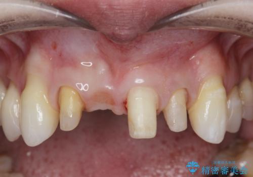 吸収し喪失した前歯、ブリッジによる審美性の回復の治療中