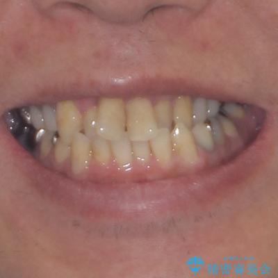 飛び出した前歯と目立つ銀歯 矯正とセラミックの総合歯科診療の治療前(顔貌)