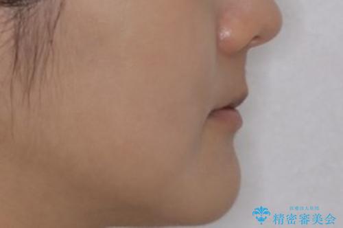 コロナ禍で矯正治療が中断:インビザラインで最終仕上げの治療後(顔貌)