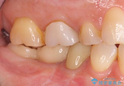 くいしばりで割れたブリッジの支台歯　インプラント再補綴の治療後