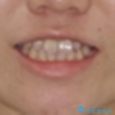前歯のデコボコを改善　ワイヤー矯正を併用したインビザライン矯正の治療前（顔貌）