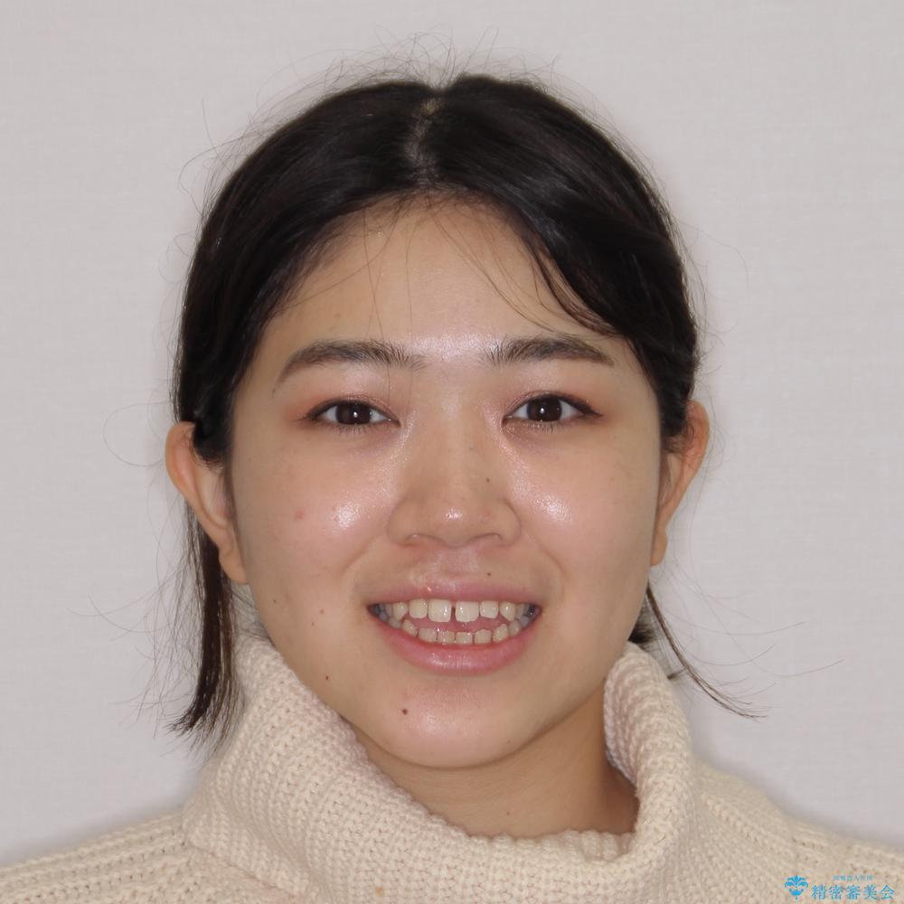 【モニター】隙間だらけの前歯を治したい　インビザラインによる矯正治療の治療前（顔貌）