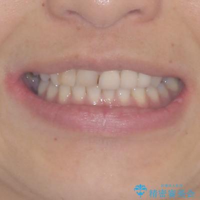 歯が全く咬みあわない　矯正と補綴の全顎治療の治療前（顔貌）