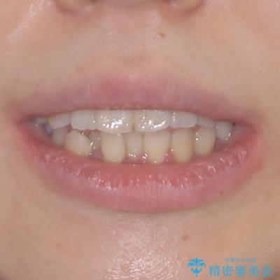 上下非接触で突出した前歯　ワイヤー装置による抜歯矯正の治療前（顔貌）