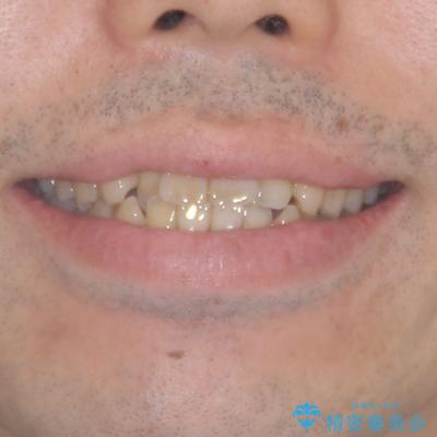 前歯のクロスバイトを改善　インビザラインによる矯正治療の治療前（顔貌）