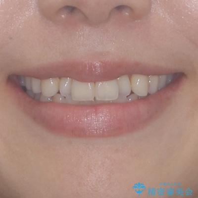 前歯のクロスバイト　インビザラインによる矯正治療の治療前（顔貌）