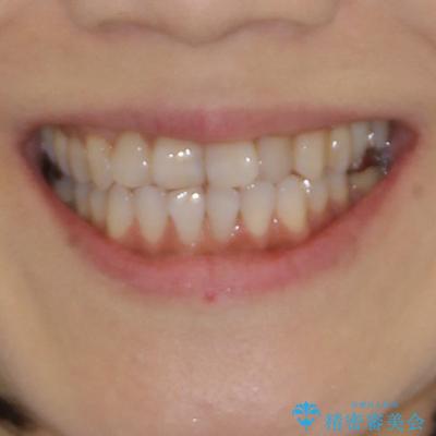 前歯の突出感と上下の隙間　インビザラインによる矯正治療の治療前（顔貌）