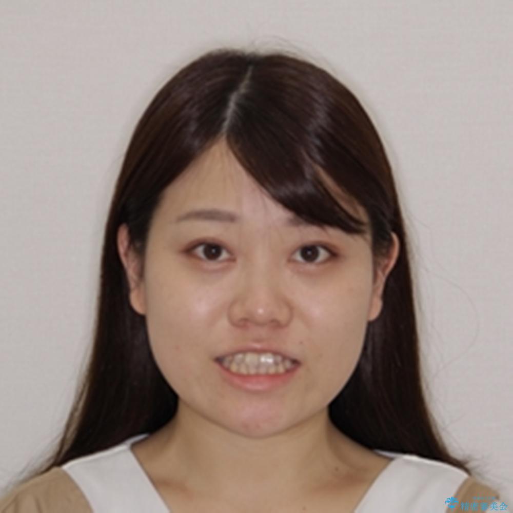 【モニター】前歯のデコボコを改善 ワイヤー矯正を併用したインビザライン矯正の治療前(顔貌)