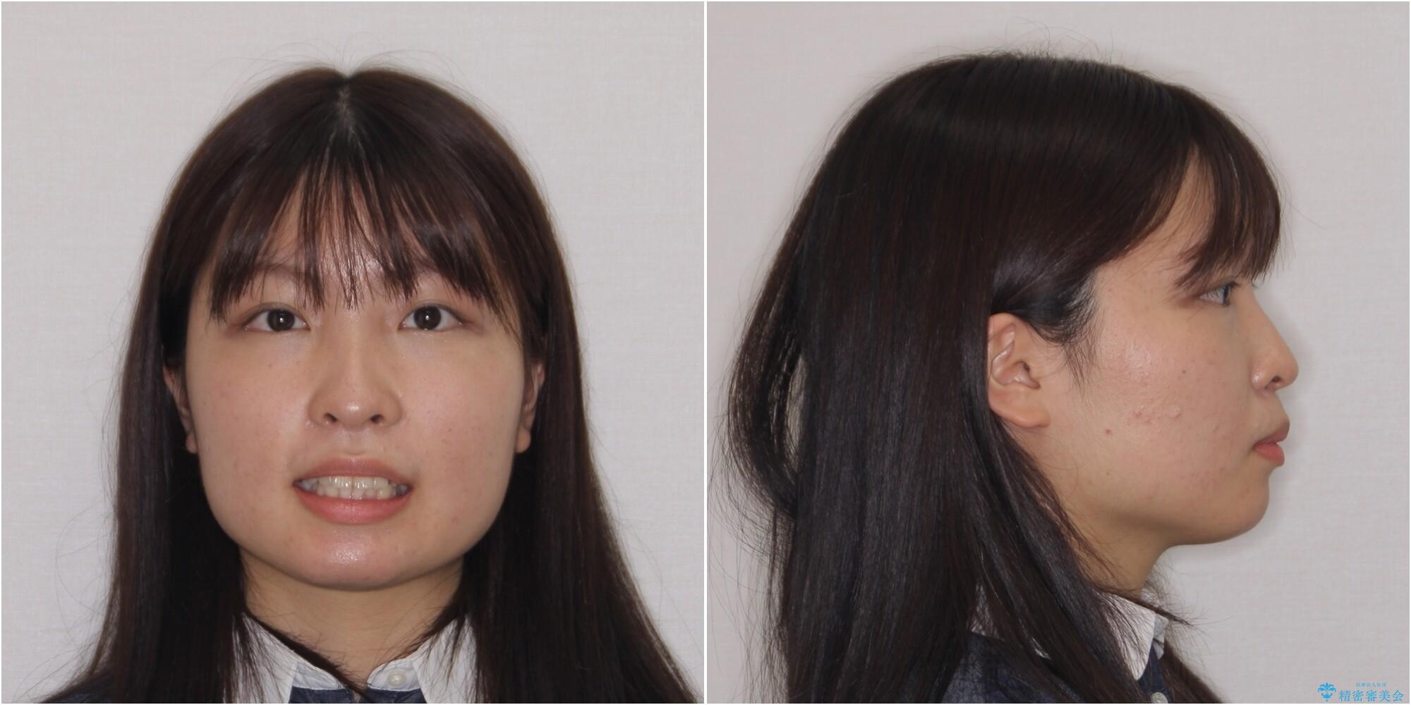 【モニター】治療途中で引っ越し ワイヤー装置を用いた抜歯矯正の治療前(顔貌)