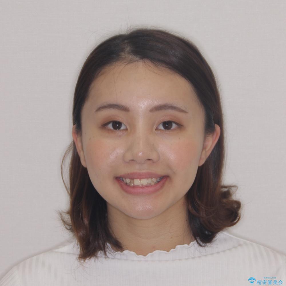 【モニター】前歯のデコボコと変色した前歯をインビザラインとオールセラミッククラウンでの治療前(顔貌)