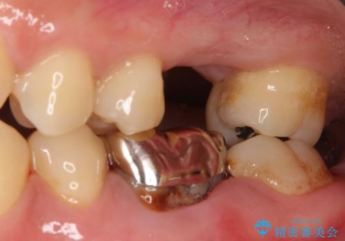 【歯牙移植】親知らずを移植して、インプラントを回避。の治療前
