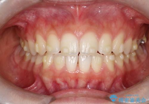 【インビザライン】前歯のすき間をなおしたい。の治療中