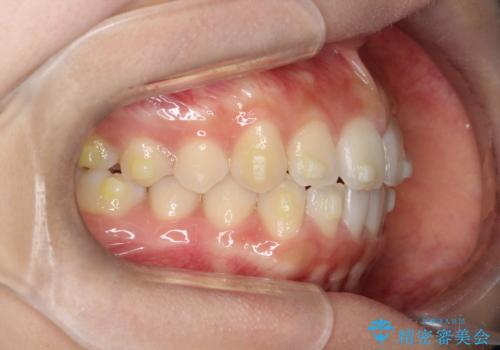 【インビザライン】前歯のすき間をなおしたい。の治療中