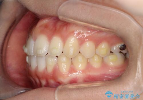 【インビザライン】前歯のすき間をなおしたい。の治療中