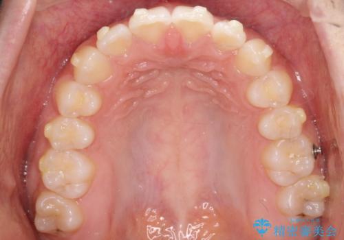 【インビザライン】前歯のすき間をなおしたい。の治療中