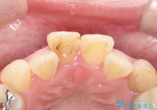 【オールセラミック】前歯の色を変えたい。の治療前