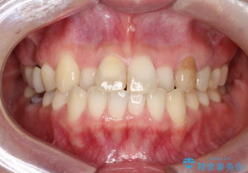 【オールセラミック】前歯の色を変えたい。の治療前