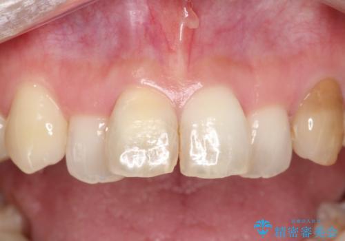 【オールセラミック】前歯の色を変えたい。の症例 治療前