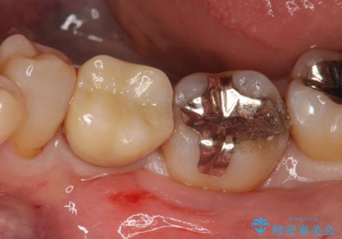 メタルインレーの下は。クラックラインを認めた歯。の治療前