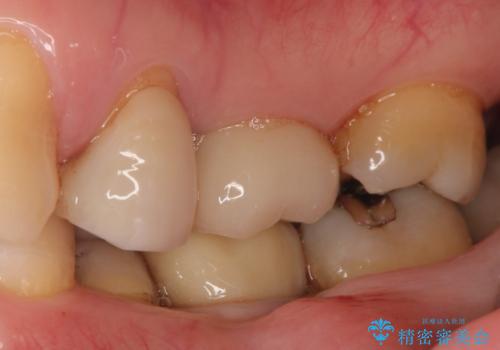 メタルインレーの下は。クラックラインを認めた歯。の治療前