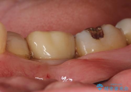 メタルインレーの下は。クラックラインを認めた歯。の治療前