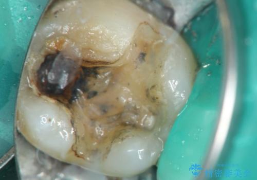 メタルインレーの下は。クラックラインを認めた歯。