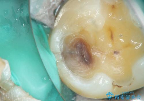 メタルインレーの下は。クラックラインを認めた歯。の治療中