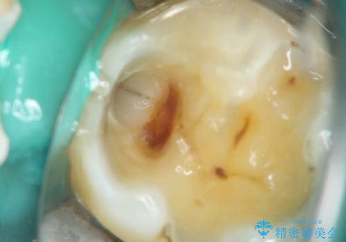 メタルインレーの下は。クラックラインを認めた歯。の治療中