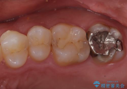 【セラミックインレー】歯科検診にて虫歯発見。の症例 治療前