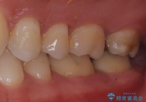 【セラミックインレー】歯科検診にて虫歯発見。の治療前