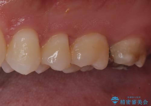 【セラミックインレー】歯科検診にて虫歯発見。の治療前