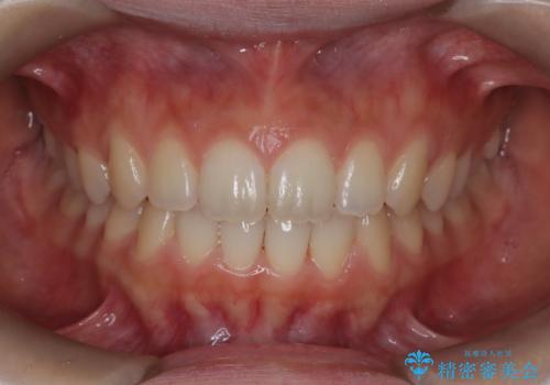 【インビザライン】前歯のすき間をなおしたい。の治療後