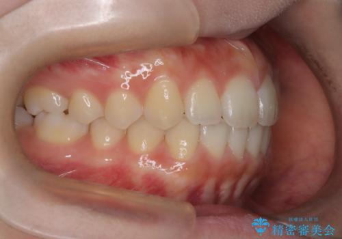 【インビザライン】前歯のすき間をなおしたい。の治療後