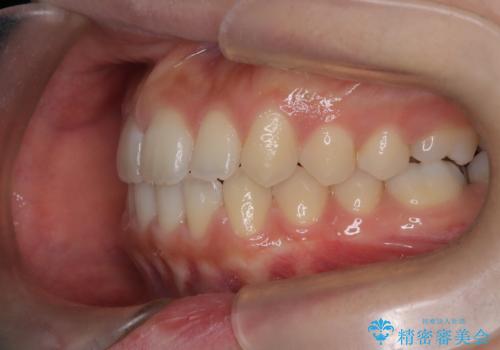 【インビザライン】前歯のすき間をなおしたい。の治療後