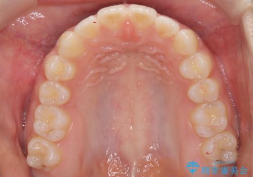 【インビザライン】前歯のすき間をなおしたい。の治療後